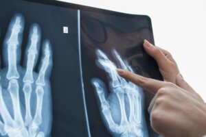 疲労骨折は分かり辛い