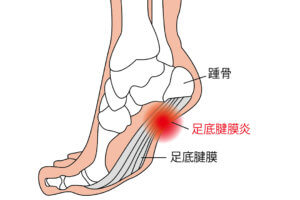 足裏腱膜炎