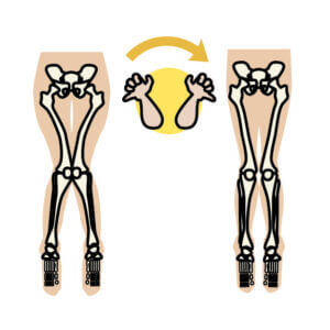 鵞足炎とX脚の関係性