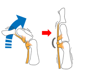 腱鞘炎(ばね指)