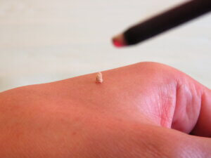 針治療にお灸を加えた「冷え取りコース」