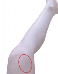 太もも内側が痛む鵞足炎